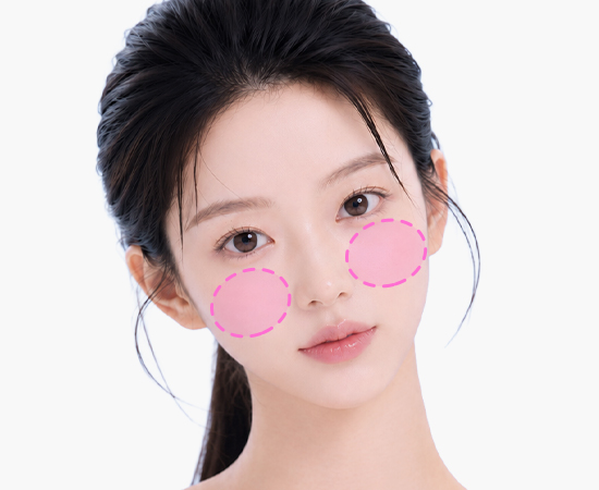 Customized 3D front cheek implant augmentation
