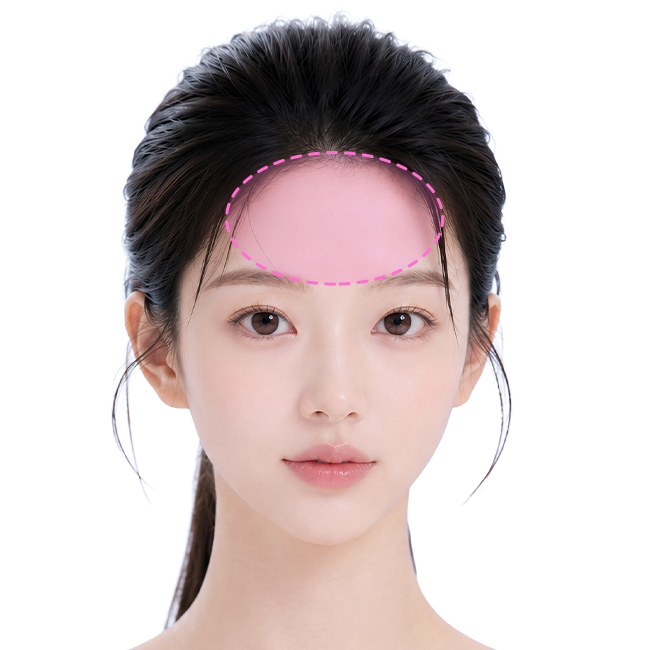 Customized 3D forehead implant augmentation