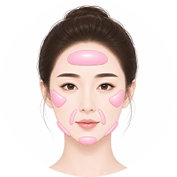 Customized facial implant placement
