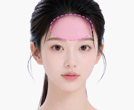 Customized 3D forehead implant augmentation