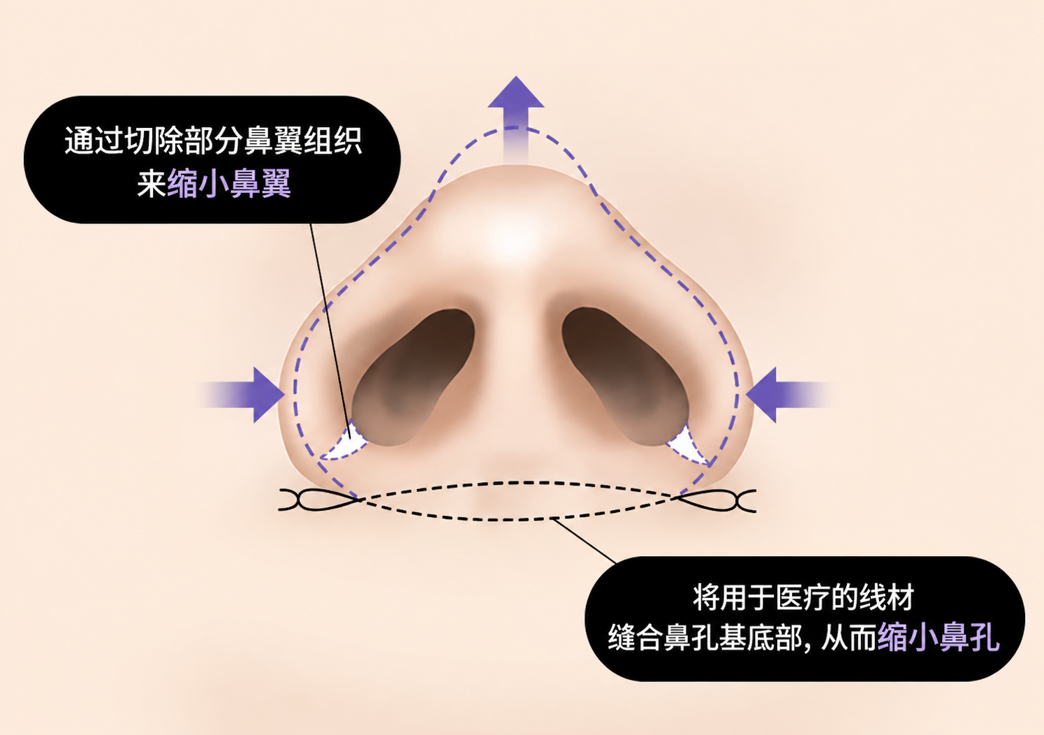 鼻翼缩小微创切口及缝合方式示意