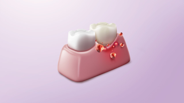 치주치료