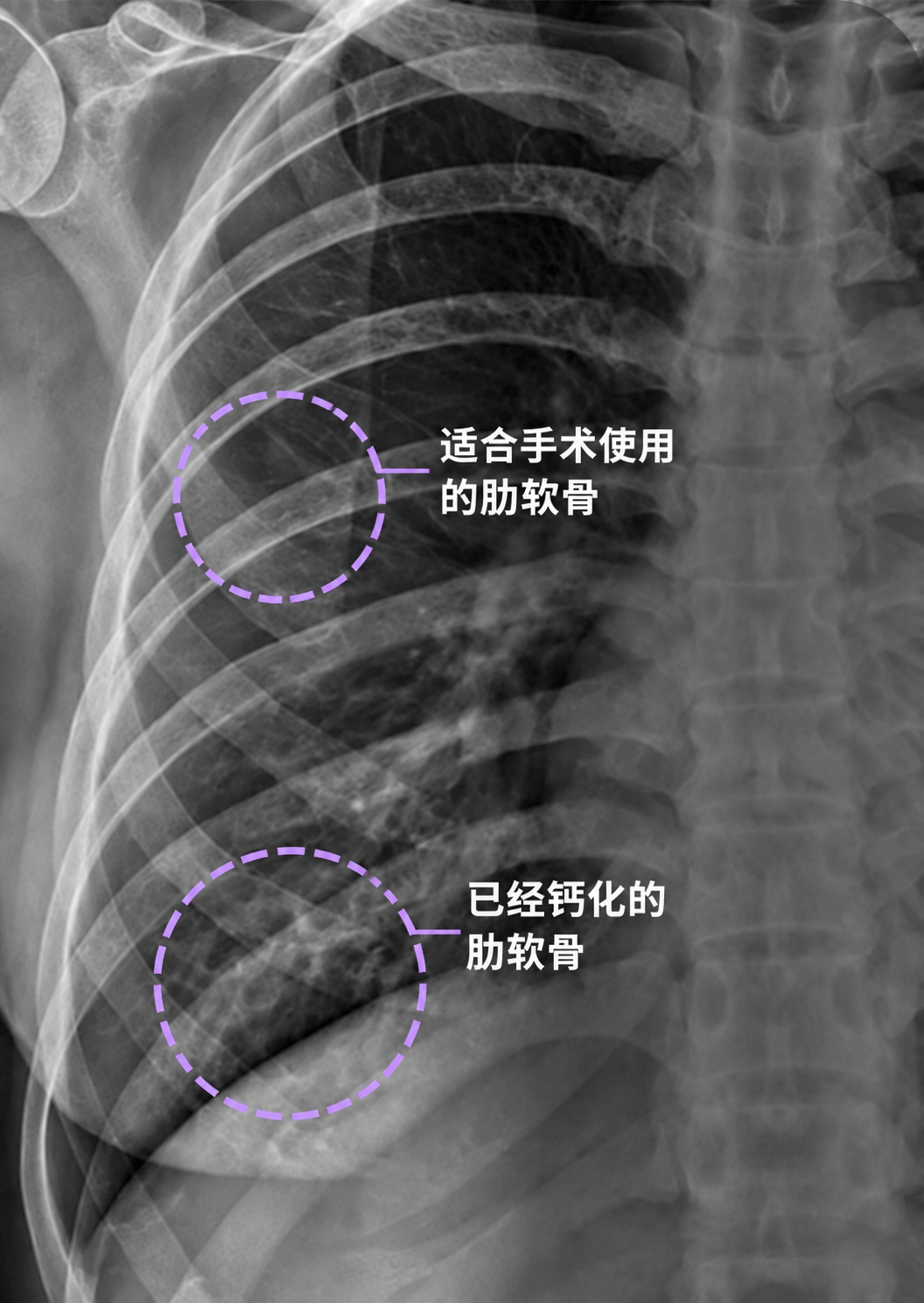 自体肋软骨隆鼻术前肋软骨钙化X-ray示例