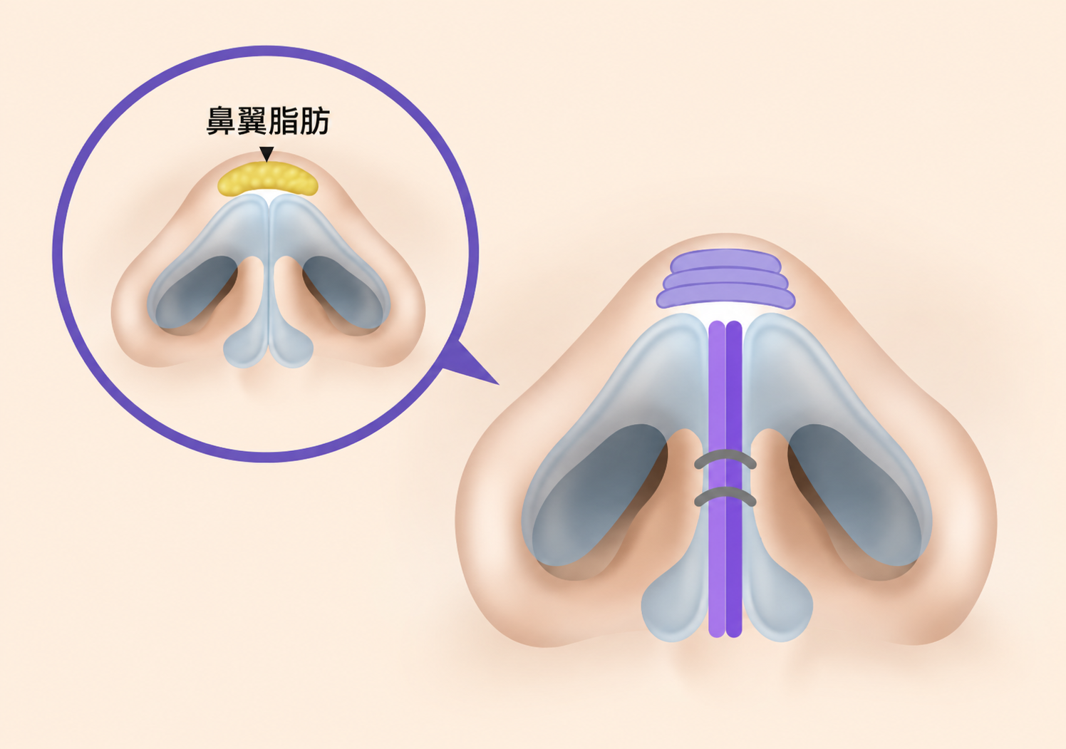 鼻尖皮下脂肪与鼻尖支撑结构示意