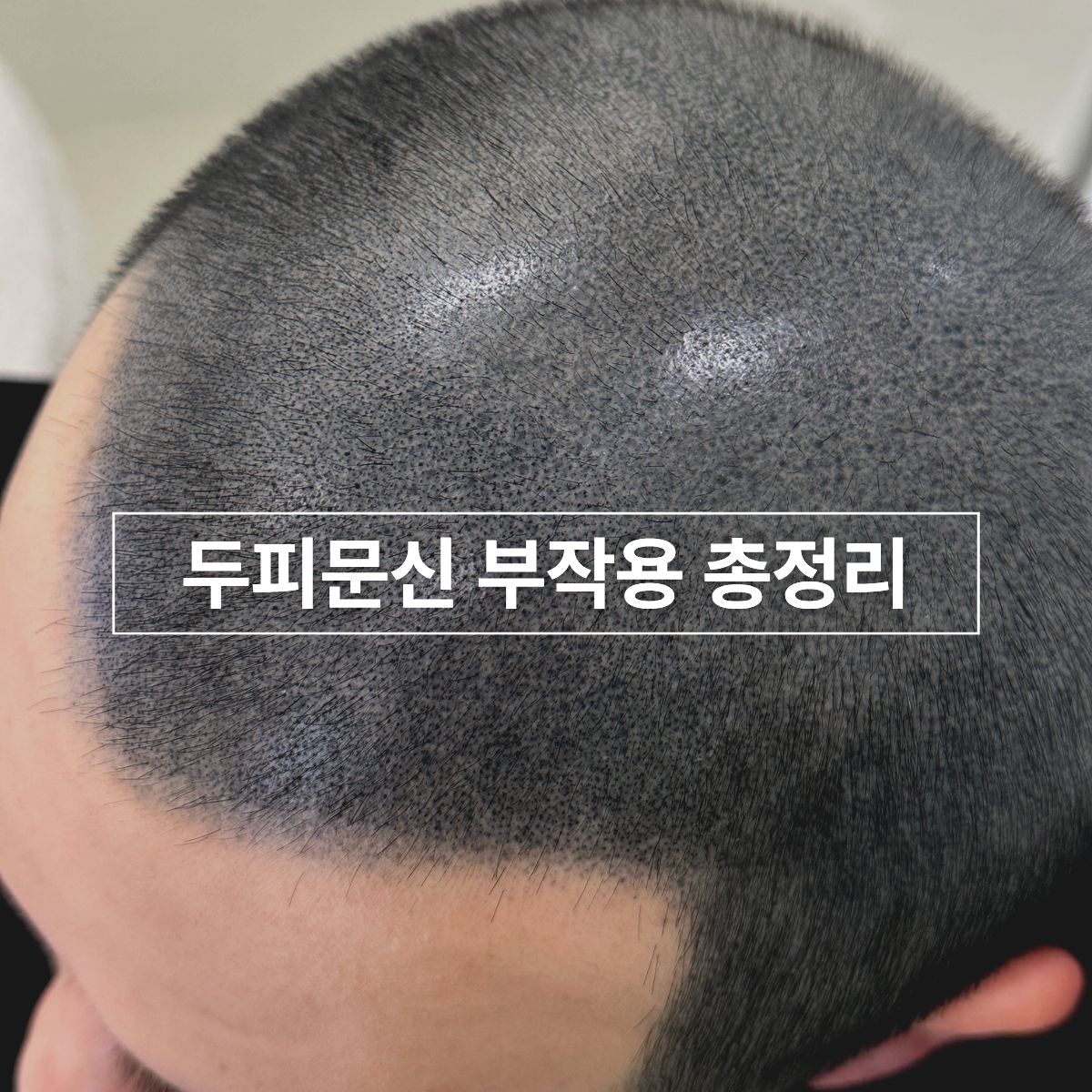 두피문신 부작용