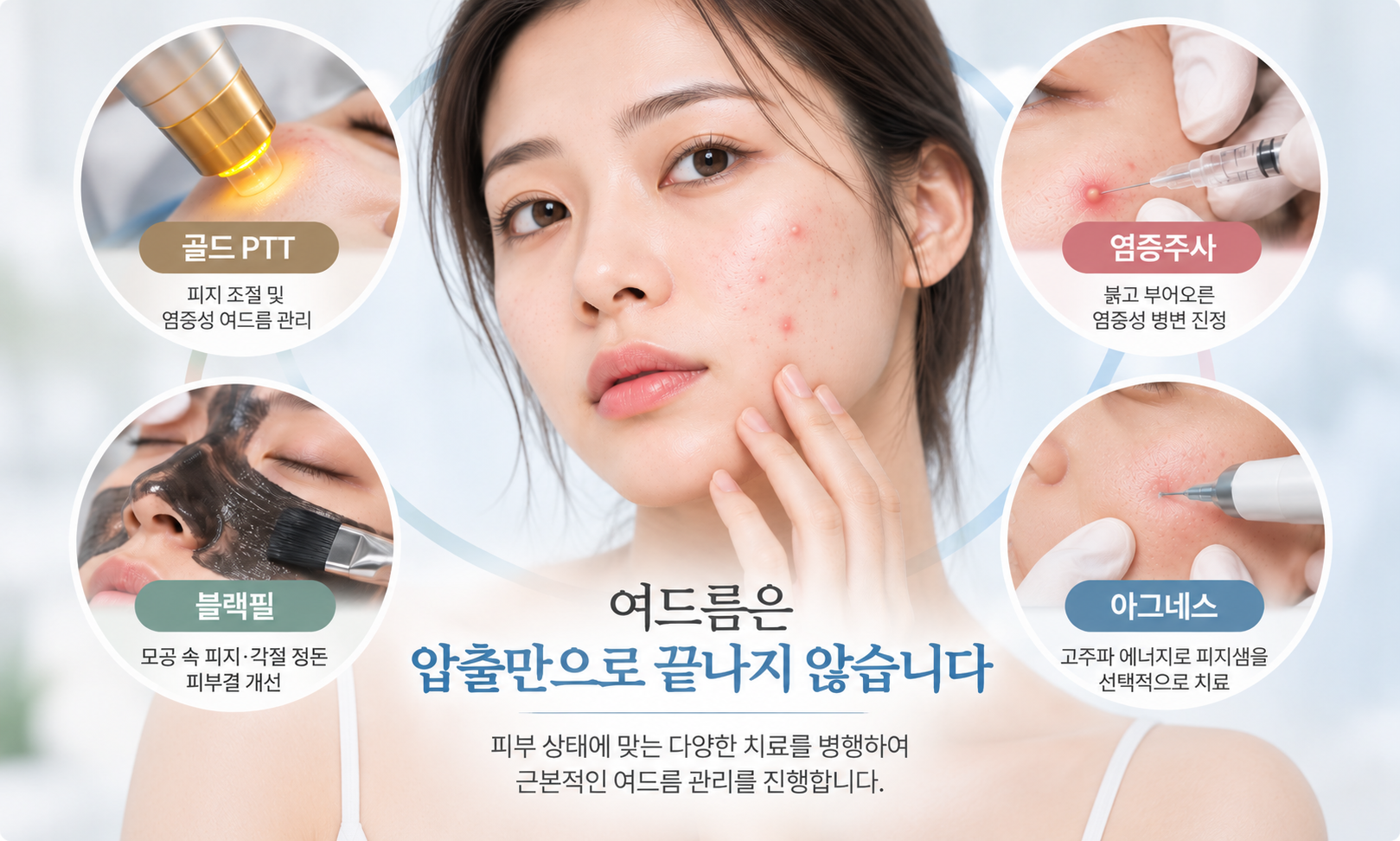 여드름 치료 방법