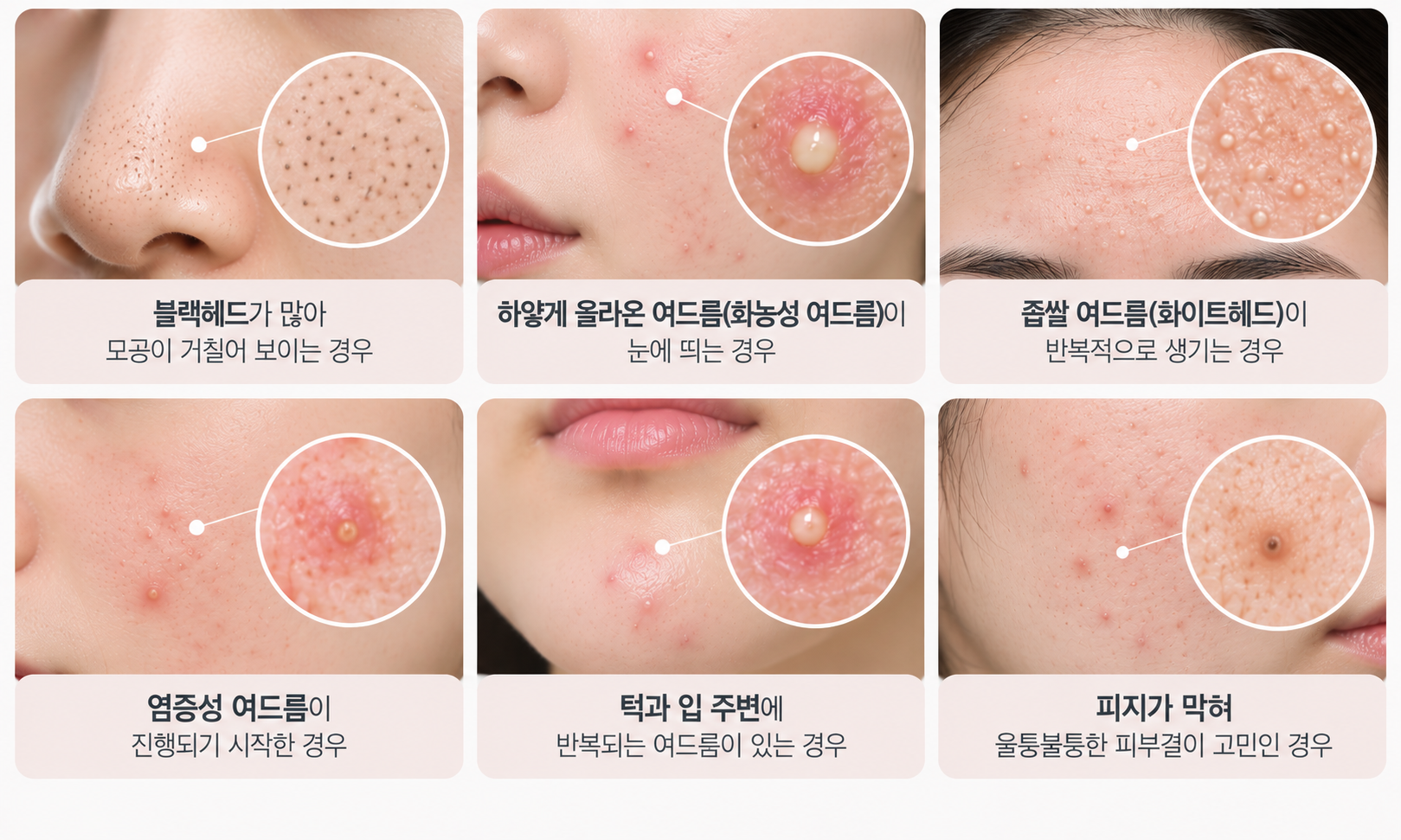 여드름 압출 추천대상