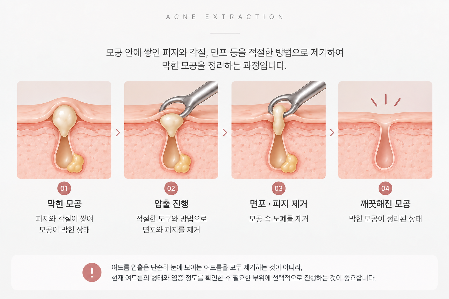 여드름 압출이란?