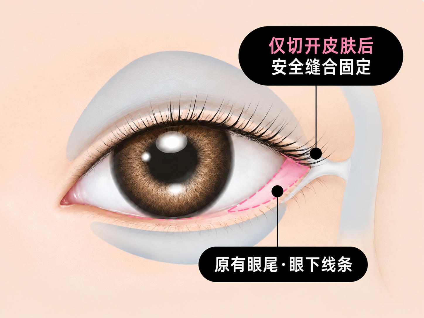 绮林7mm外眼角下至