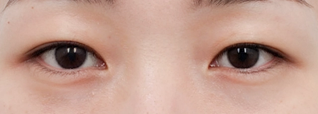 眼综合案例1手术前