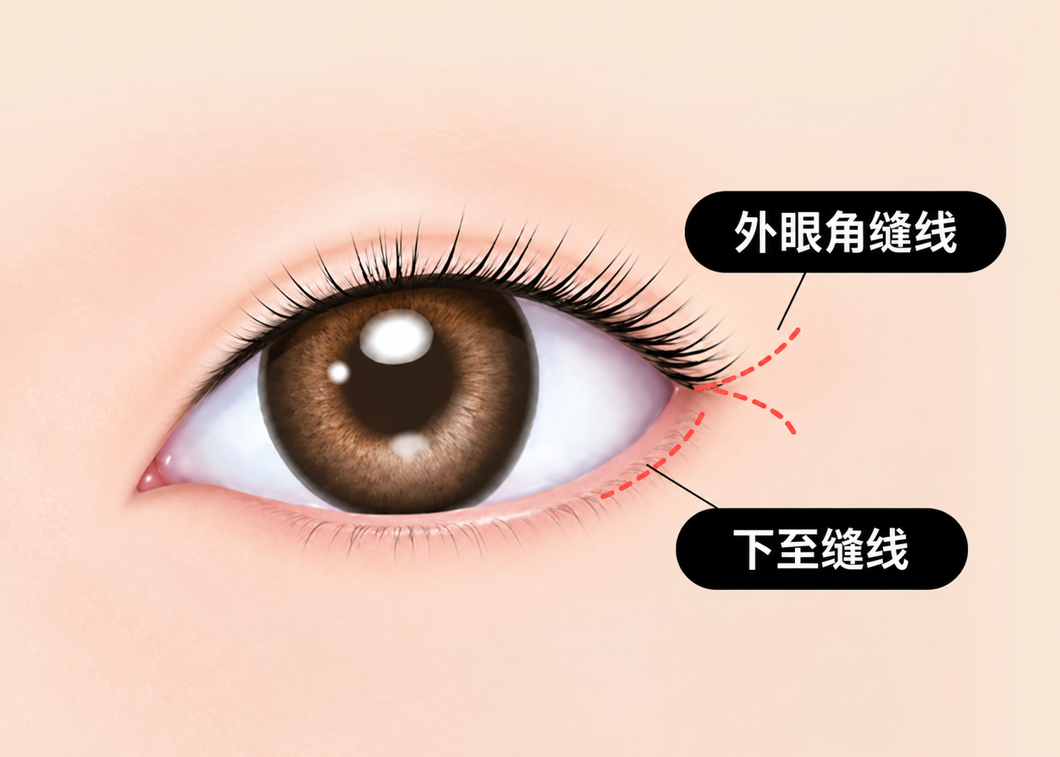 7mm外眼角下至步骤4
