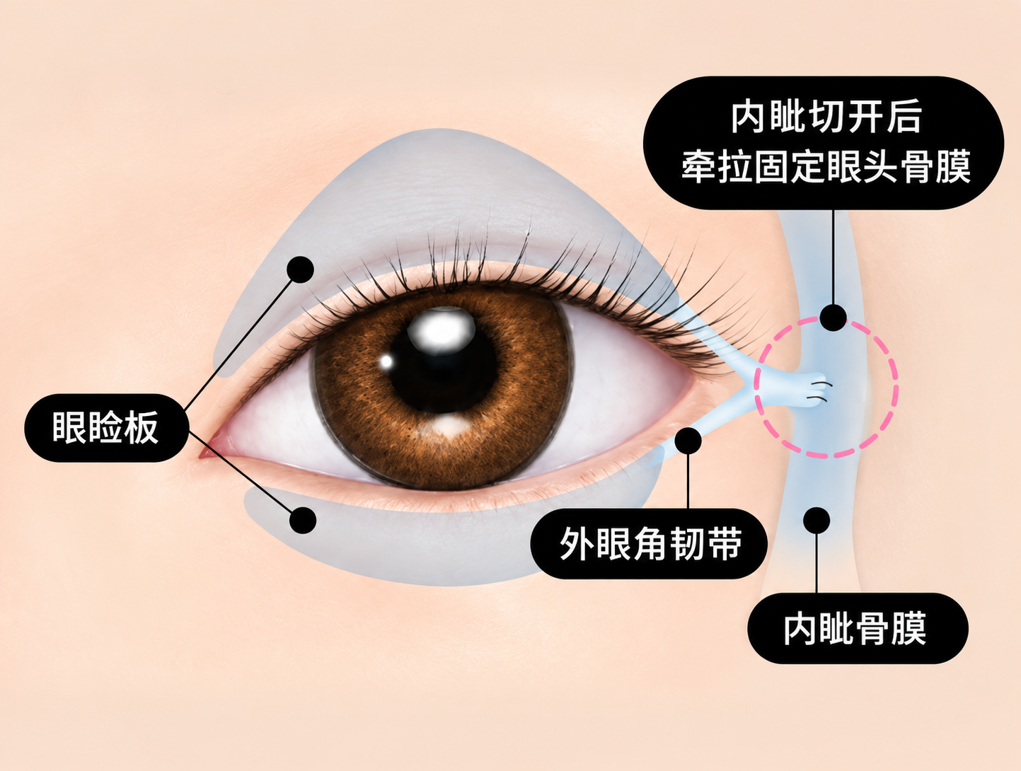 传统外眼角