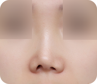 Revision rhinoplasty before case 3