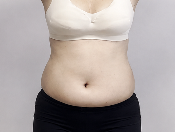 Abdominal liposuction before
