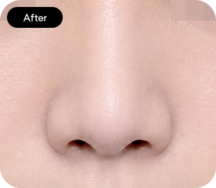Bulbous nose rhinoplasty after case 6