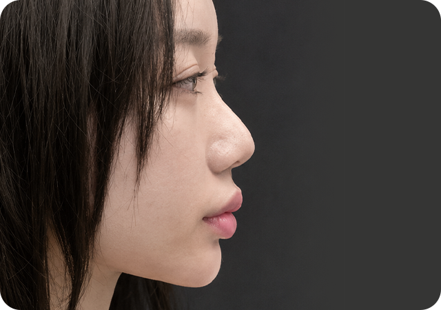 Before rhinoplasty profile