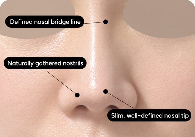 Bulbous nose after surgery