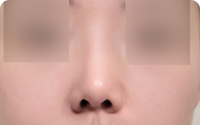 Revision rhinoplasty after