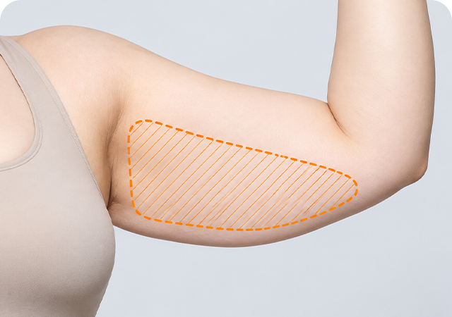 Arm lift step 1