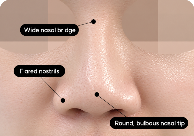 Bulbous nose before surgery