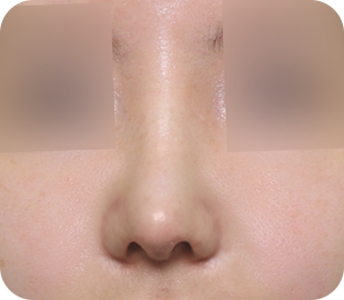 Revision rhinoplasty after case 1