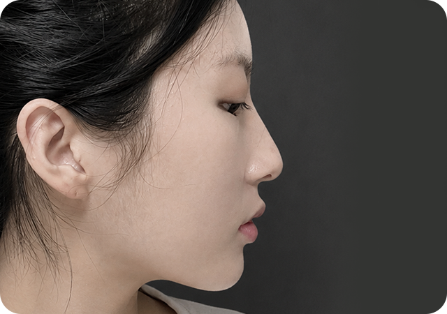 Before rhinoplasty side view