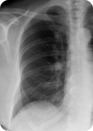 Normal rib cartilage X-ray