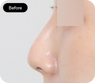 Low-bridge rhinoplasty before case 3
