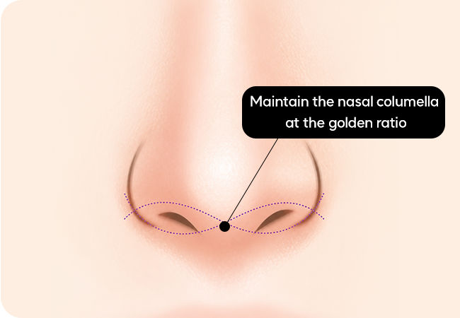 Non-incisional nostril reduction