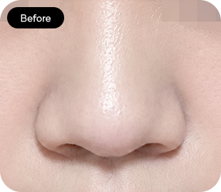 Bulbous nose rhinoplasty before case 6