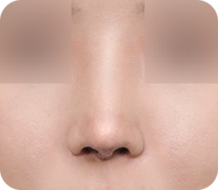 Revision rhinoplasty after case 4