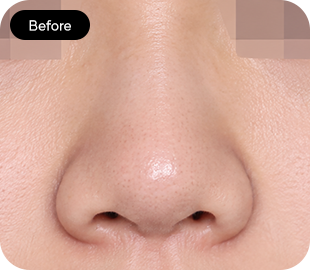 Bulbous nose rhinoplasty before case 2