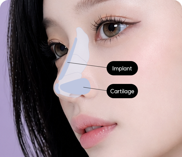 Rhinoplasty plan based on nasal structure