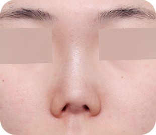 Revision rhinoplasty before case 8