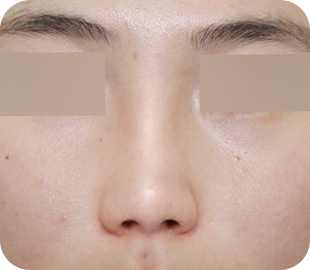 Revision rhinoplasty after case 8