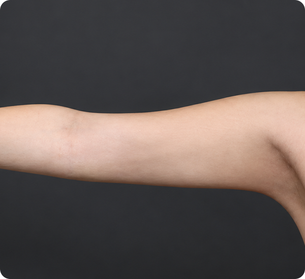 Arm lift case 02 six months after