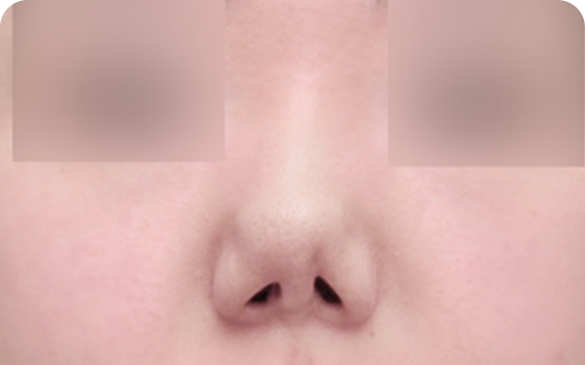 Revision rhinoplasty before
