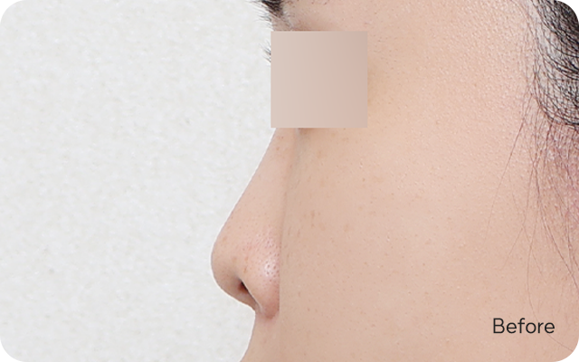 Low-bridge rhinoplasty before