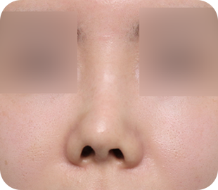 Revision rhinoplasty before case 1