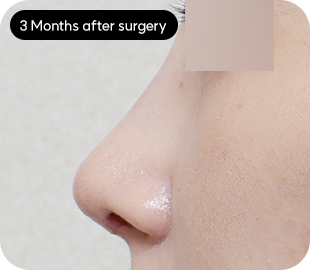 Low-bridge rhinoplasty after case 3