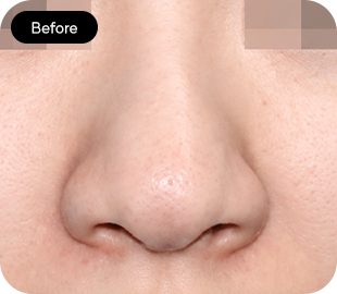 Bulbous nose rhinoplasty before case 5