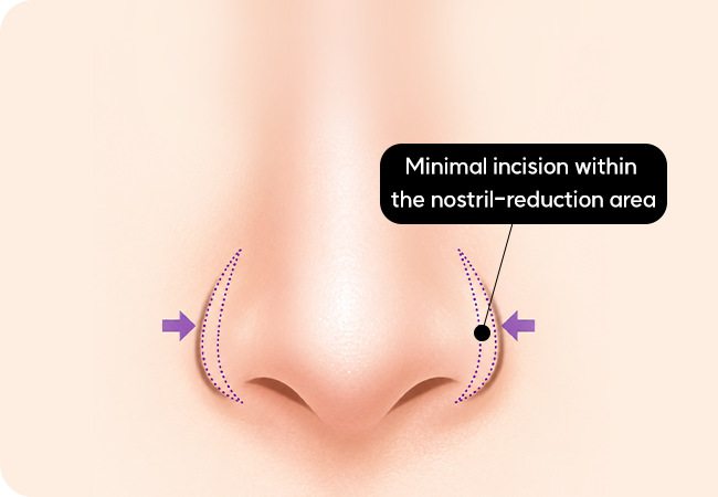 Incisional nostril reduction