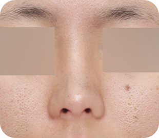 Revision rhinoplasty after case 6