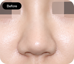 Bulbous nose rhinoplasty before case 4