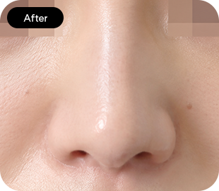 Bulbous nose rhinoplasty after case 3