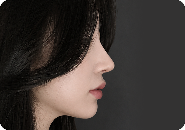After rhinoplasty side view
