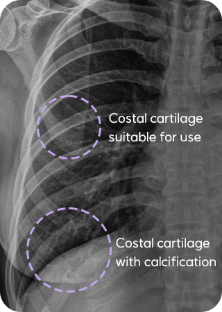 Calcified rib cartilage X-ray