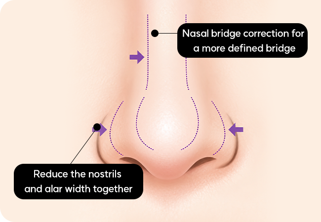 Bulbous nose correction