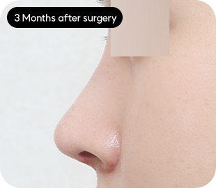 Low-bridge rhinoplasty after case 2
