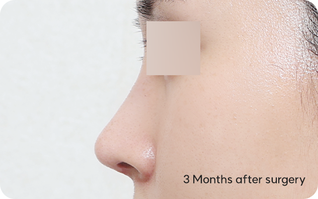Low-bridge rhinoplasty three months after